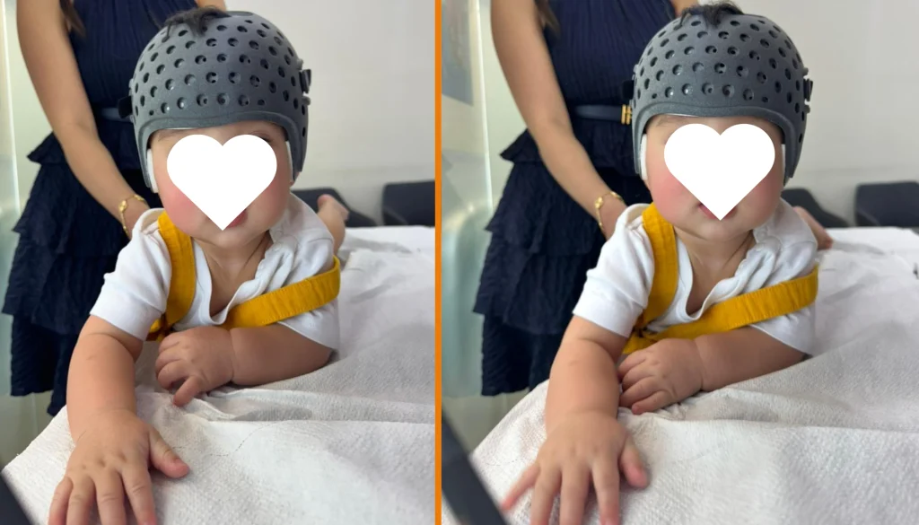cranial helmet for baby