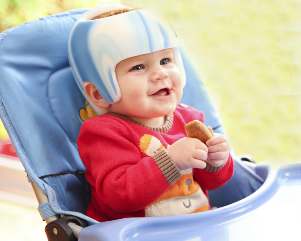 Helmet therapy for your baby
