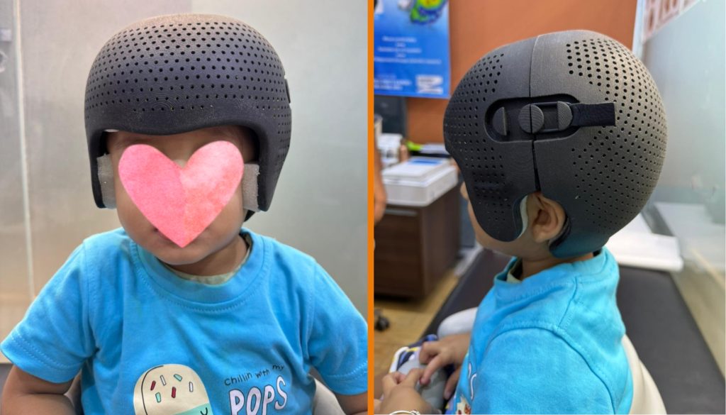 flat head syndrome treatment