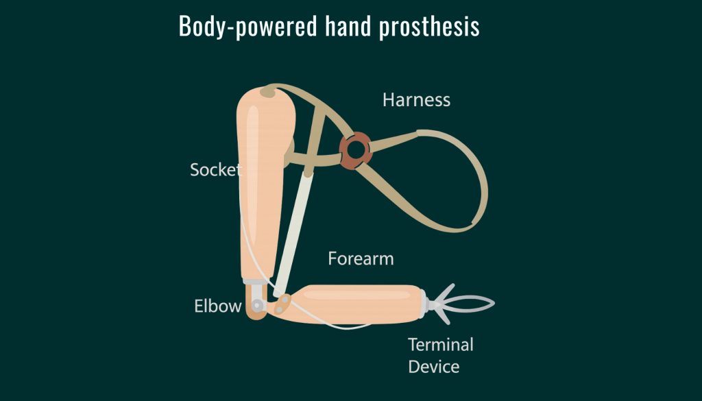 Body-powered hand prosthesis