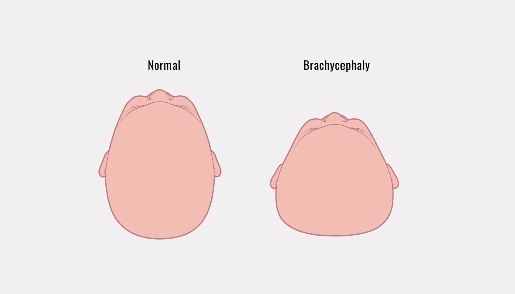 Brachycephaly