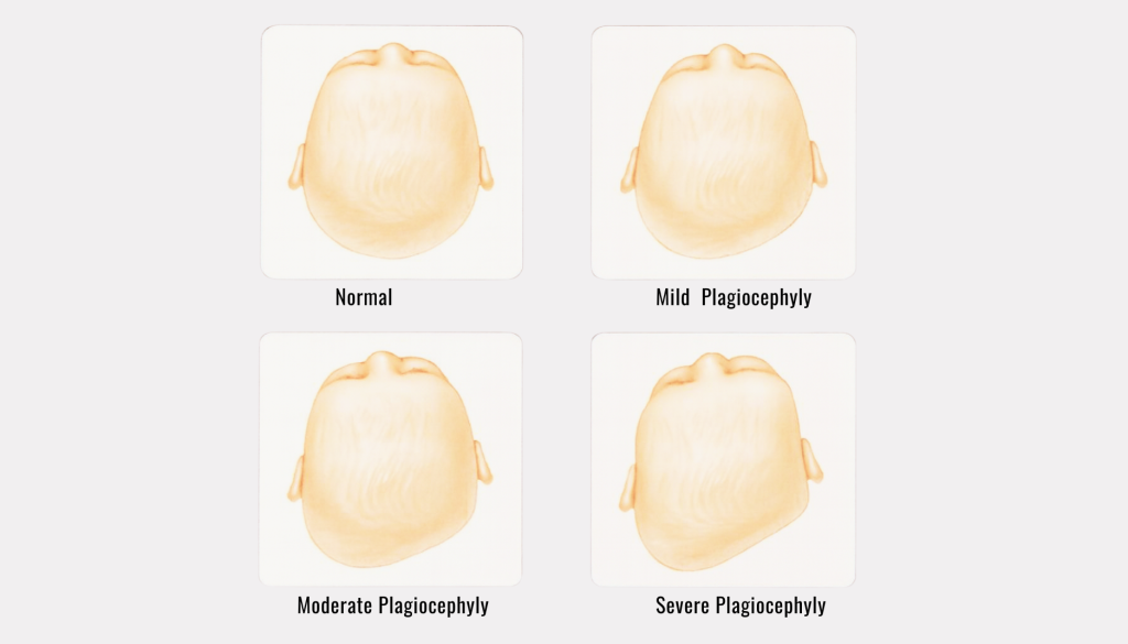 Plagiocephaly