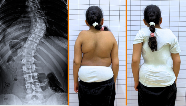Back Brace for Scoliosis