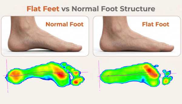 flat feet pain